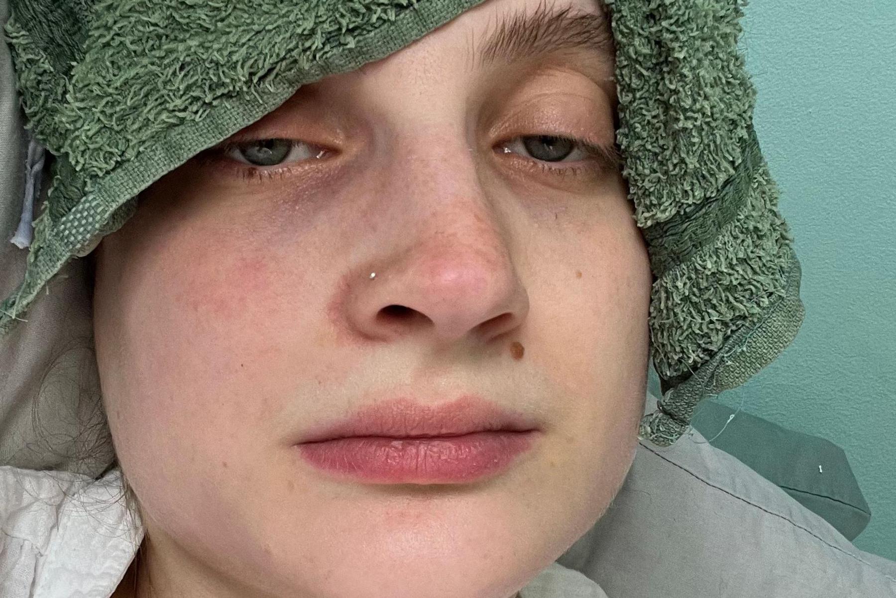 Woman looking unwell with a wet flannel on her forehead.