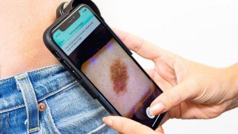 A phone with an app to analyse moles and lesions for skin cancer is being used on a person. The phone is being held by a hand. It is being held against a person's skin. A mole is visible on the phone screen. The person is wearing jeans.