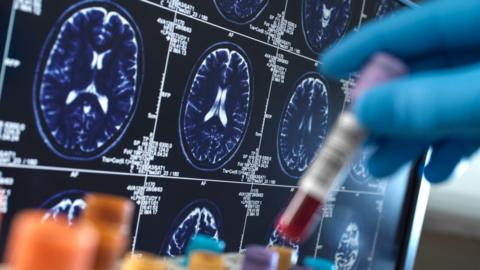 Brain scans in the background in a dark blue, while a gloved hand holds a medical vial in the foreground