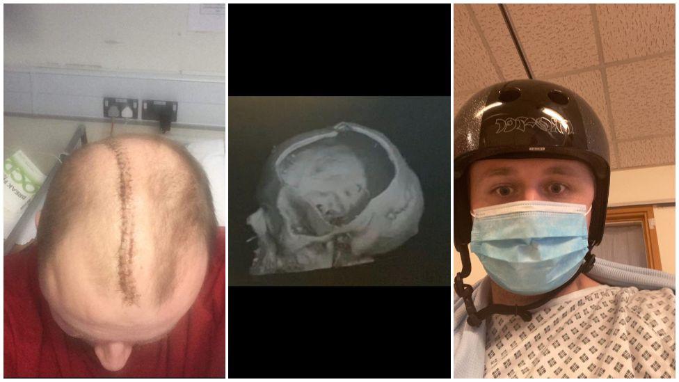 Two pictures of David on either side of an x ray showing a hole covering half a skull. on the left the picture shows the top of David's head, with a scar from his forehead to the back of his head out of site. In the other picture he is wearing a black helmet.