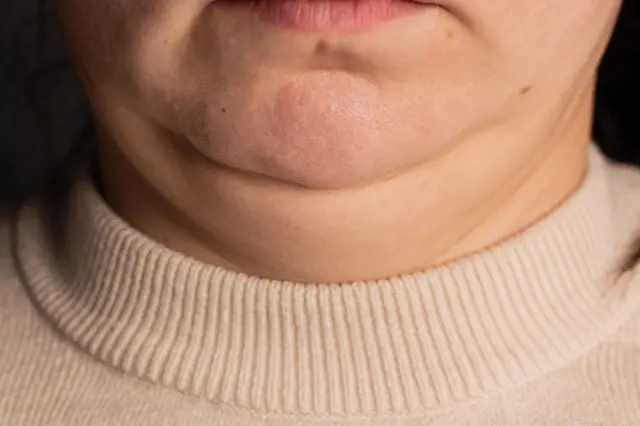 የአንድን ሰው ከአገጭ እስከ አንገት ድረስ የሚያሳይ ምስል። የአንገት ቆዳው የላላ ነው።