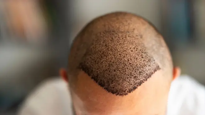 የፀጉር ንቅለ ተከላ